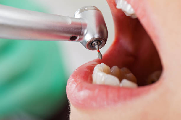 Best Emergency Tooth Extraction in Louisville, TN